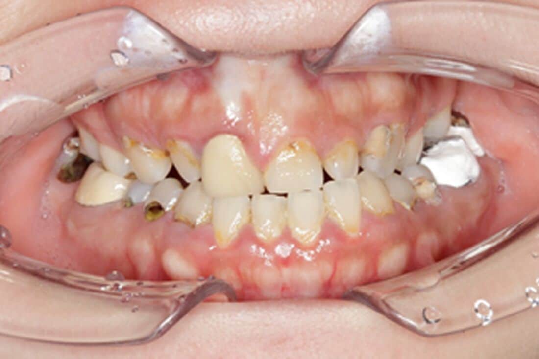 牙齒大小不一/凌亂改善運用牙齒美白貼片(療程前)－台北牙醫推薦－林書廷醫師