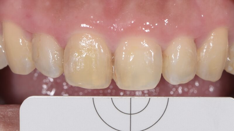 療程前－門牙全瓷冠－台北牙醫推薦－林書廷醫師