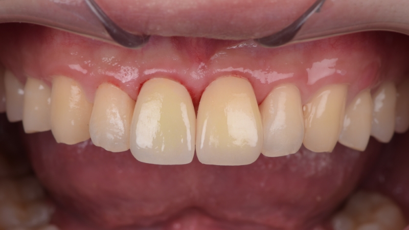 療程後－車禍門牙斷裂－用門牙貼片恢復－台北牙醫推薦－林書廷醫師