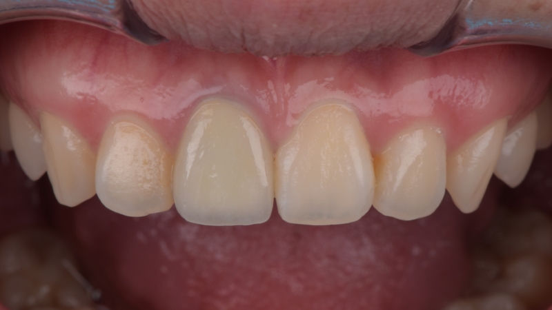 療程前－門牙假牙更換－台北全瓷冠牙醫推薦－林書廷醫師