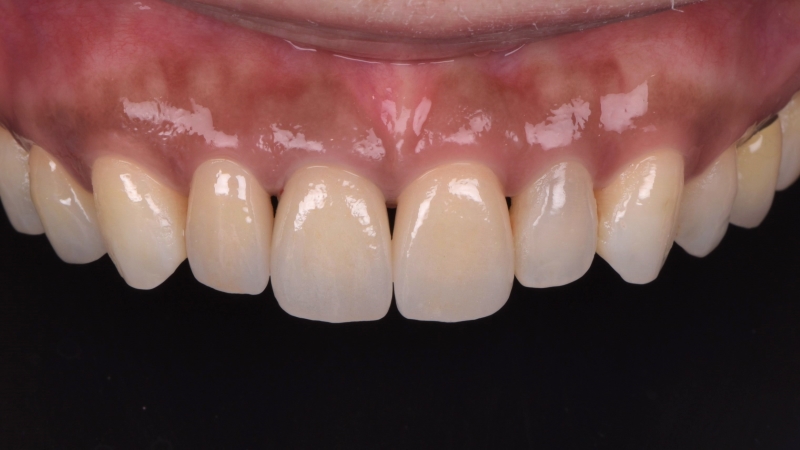 療程後－門牙長短不一－門牙陶瓷貼片－台北牙醫推薦－林書廷醫師