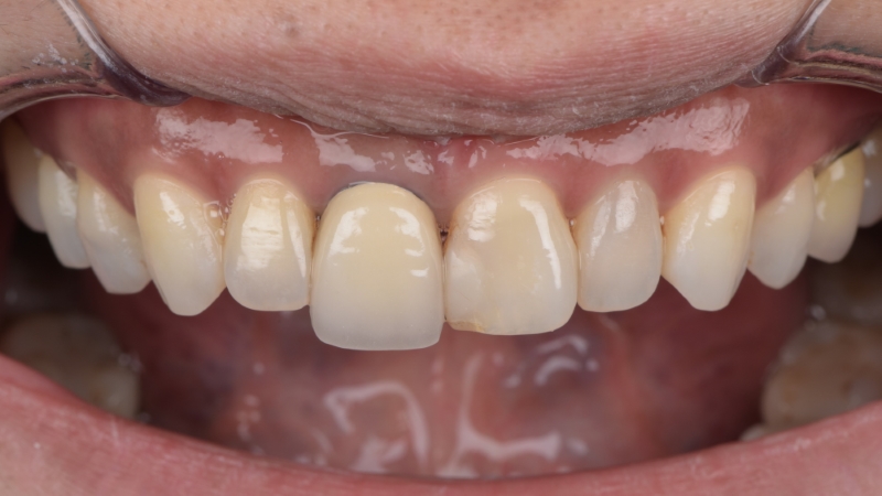 療程前－門牙長短不一－門牙陶瓷貼片－台北牙醫推薦－林書廷醫師