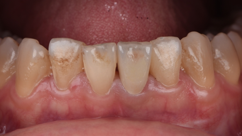 療程後－下排牙齒全瓷冠－台北牙醫推薦－林書廷醫師