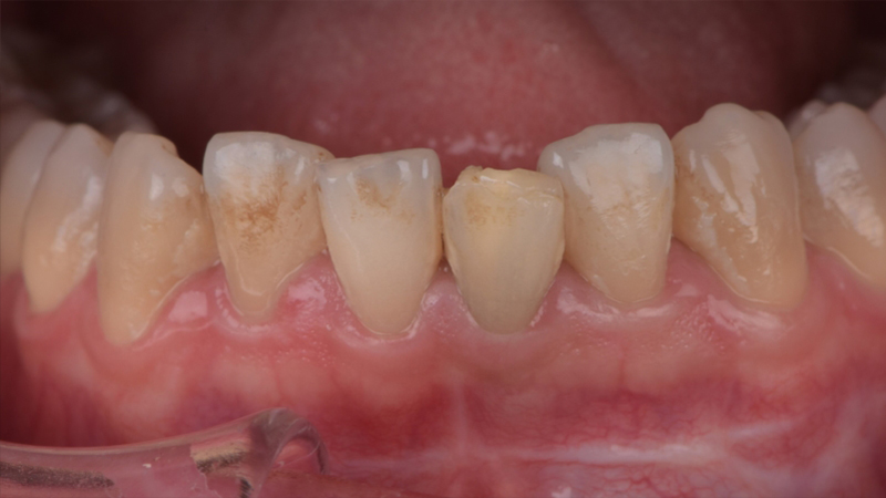 療程前－下排牙齒全瓷冠－台北牙醫推薦－林書廷醫師